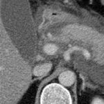Immediate drainage of infected necrotizing pancreatitis shows no benefit over postponed drainage