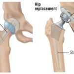 Cemented hemiarthroplasty improves quality of life for intracapsular hip fracture patients