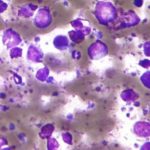 Axicabtagene ciloleucel improves event-free survival in relapsed or refractory large B-cell lymphoma