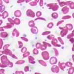 LentiGlobin efficacious for sickle cell disease hemolysis and vaso-occlusion