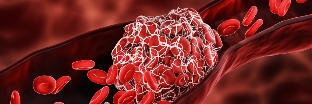 Blood Clot or thrombus blocking the red blood cells stream within an artery or a vein 3D rendering illustration. Thrombosis, cardiovascular system, medicine, biology, health, anatomy, pathology concepts.