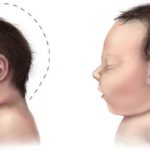 Congenital Zika syndrome is associated with higher risk of death