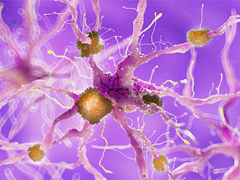 AAN Issues Review of Evidence for Aducanumab in Alzheimer Disease