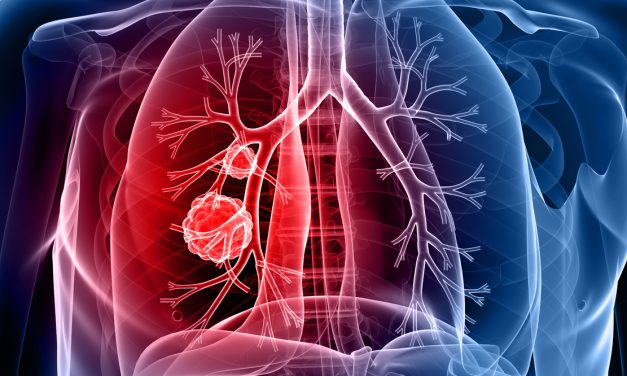 Sublobar Resection Not Inferior to Lobectomy in Early-Stage NSCLC