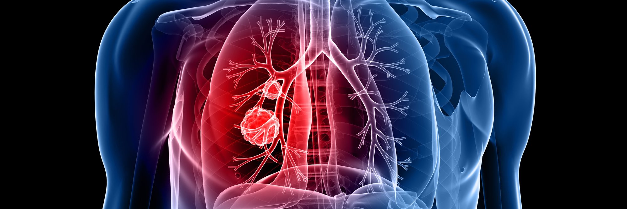 Challenges Involved in Managing Older Patients With GPA at Risk of Developing Lung Cancer