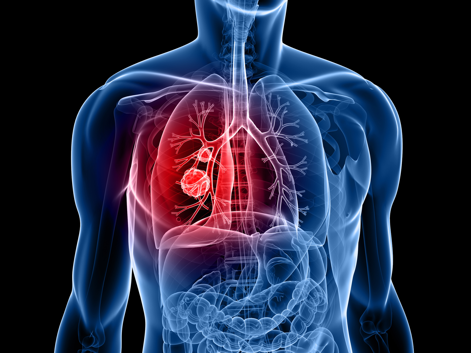 Lung Cancer: Prevalence and Impact of Medical Comorbidities