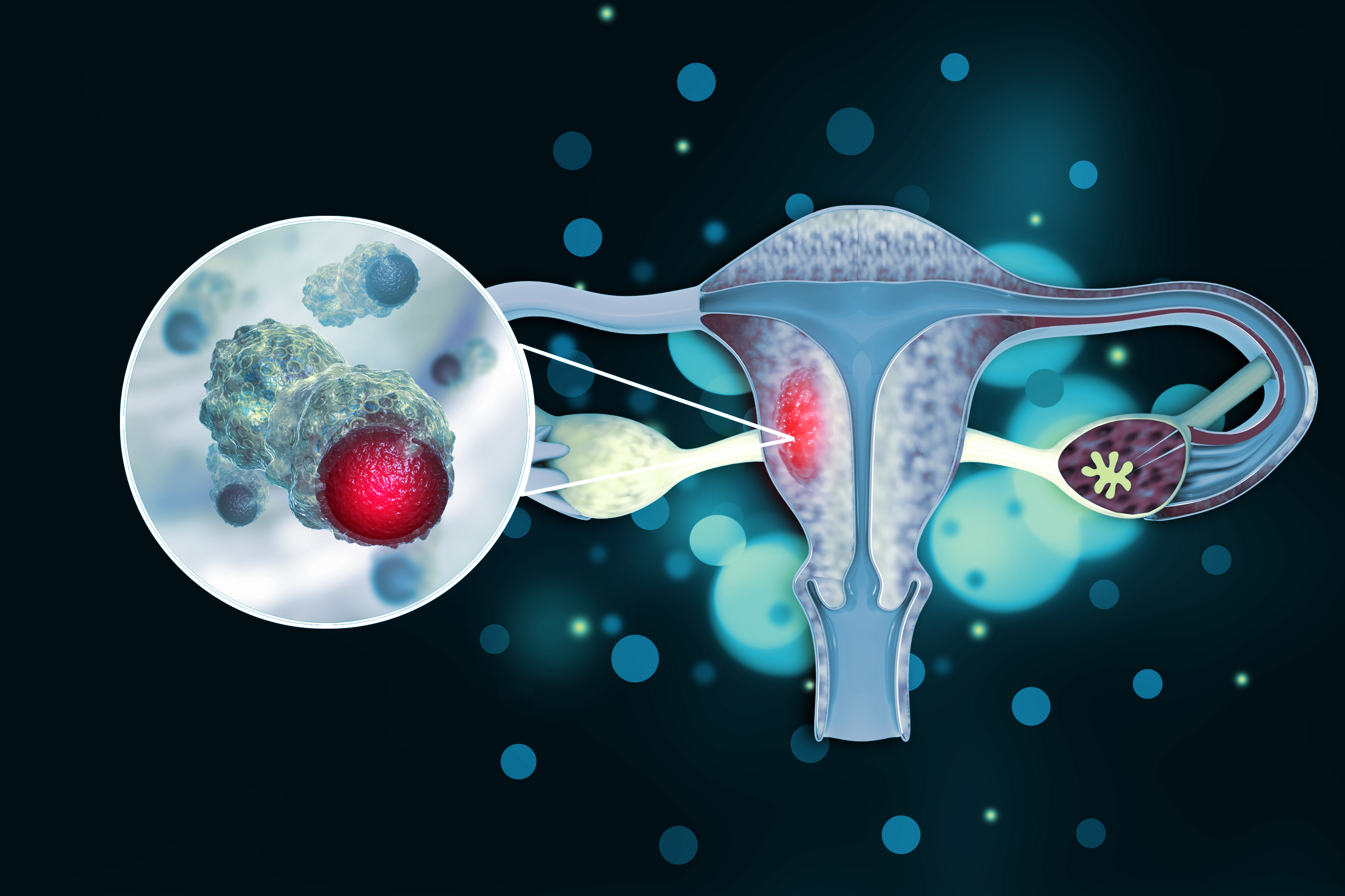 Uterus cancer, endometrial