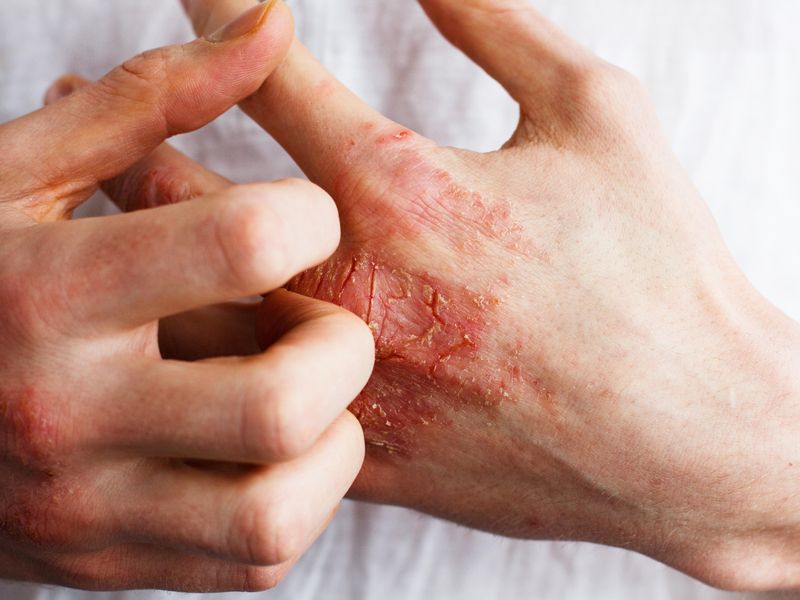 Inflammatory Skin Diseases Classified at Molecular Level