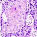 Elevated neutrophil-lymphocyte ratio associated with poor prognosis for head and neck cancer