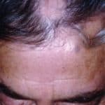 Baricitinib is superior to placebo for treatment of alopecia areata