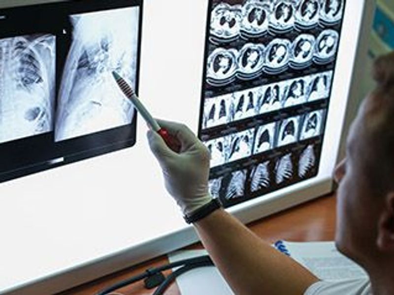 Emphysema on CT Linked to Increased Risk for Lung Cancer