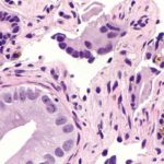 Abiraterone plus prednisone improves survival in patients with de novo metastatic castration-sensitive prostate cancer