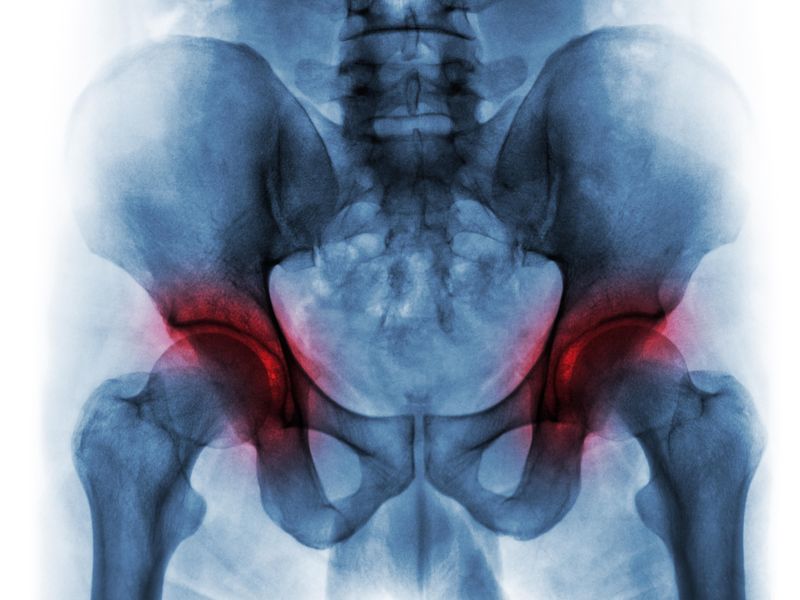 TXA Seems Safe for Surgery in High-Risk Patients With IT Hip Fracture
