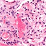 Oral methylprednisolone may reduce risk of progressive renal failure in patients with IgA nephropathy: TESTING Trial