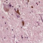 Early onset Lewy Body Dementia is more clinically distinct from Alzheimer Dementia than late onset Lewy Body Dementia