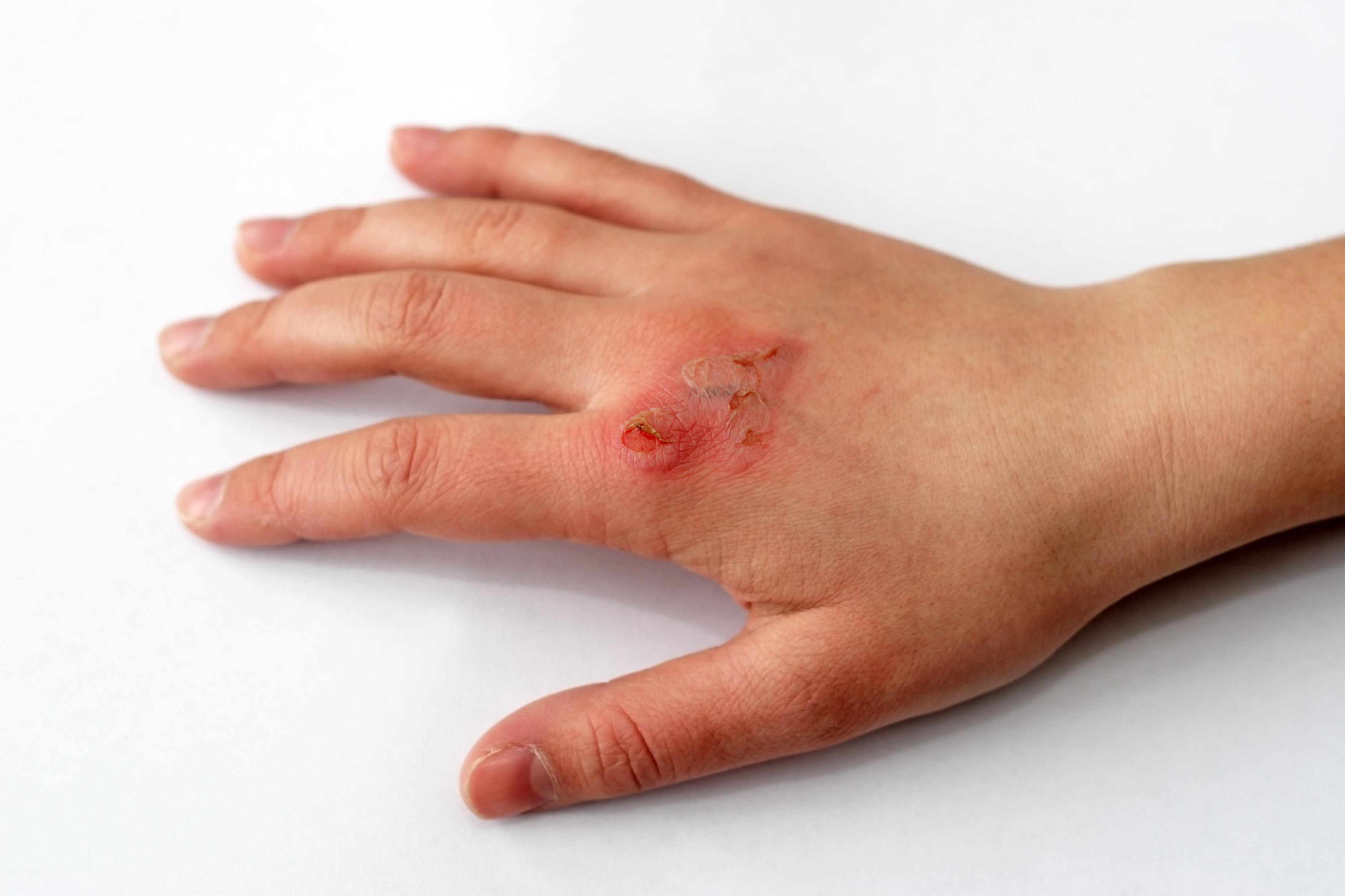 American Emergency Departments’ Epidemiology of Hand and Finger Lacerations