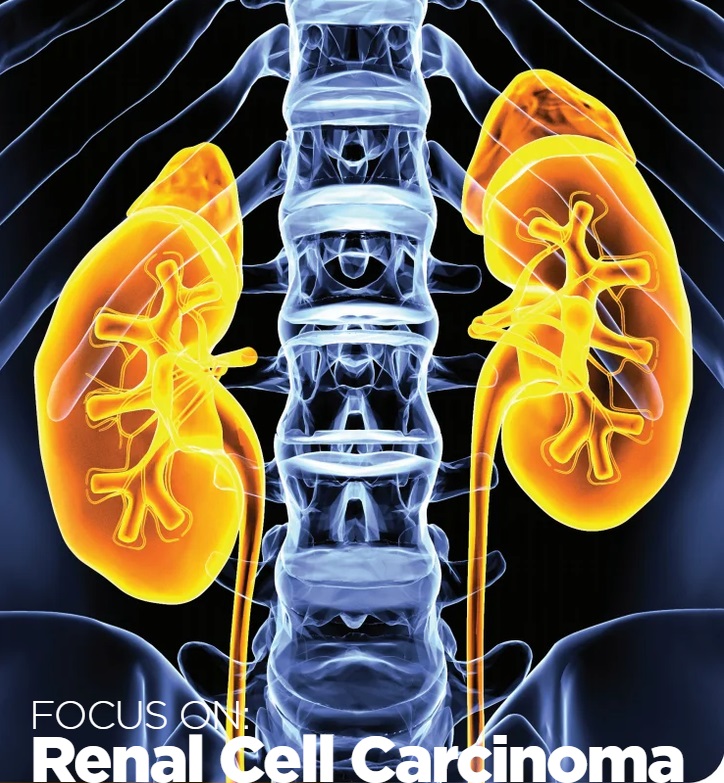 Renal Cell Carcinoma eBook