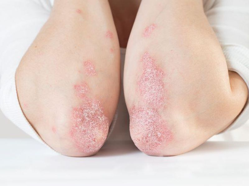 Psoriasis Tied to Higher Risk for Nonalcoholic Fatty Liver Disease