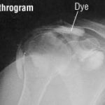 Subacromial balloon spacer not effective for management of irreparable rotator cuff tears