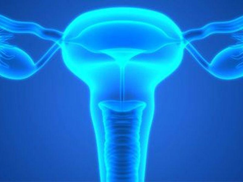 BRCA-Mutated and Homologous Recombination Deficient Ovarian Cancer Treated with Olaparib
