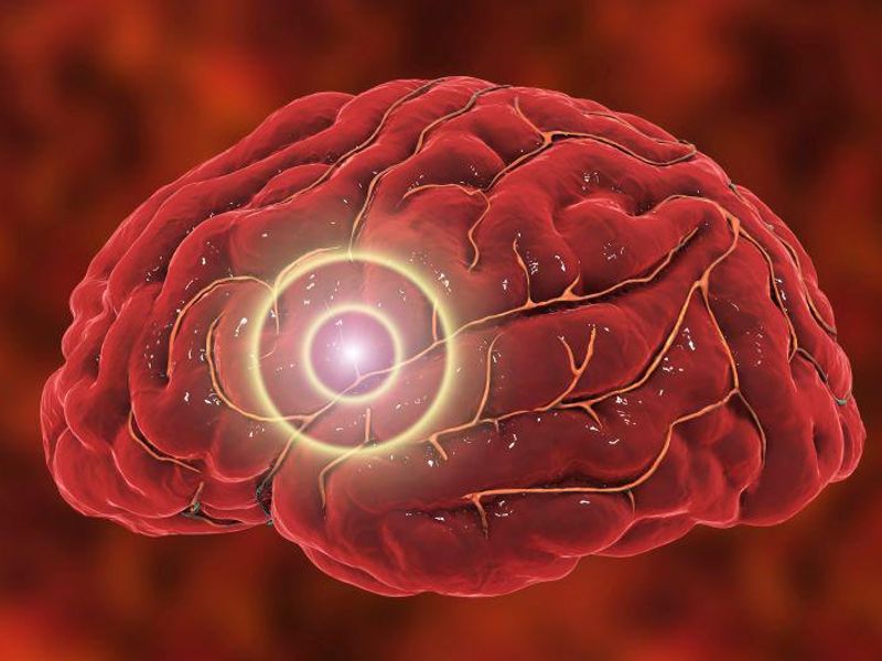 RAAS Inhibitors May Cut Risk for Rupture in Brain Aneurysm