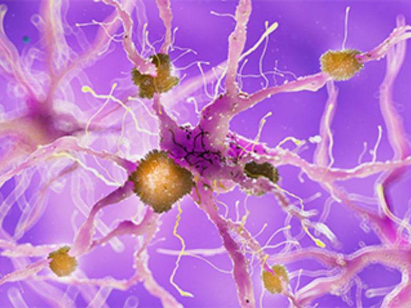 New Alzheimer Disease Drug Delivers Disappointing Results
