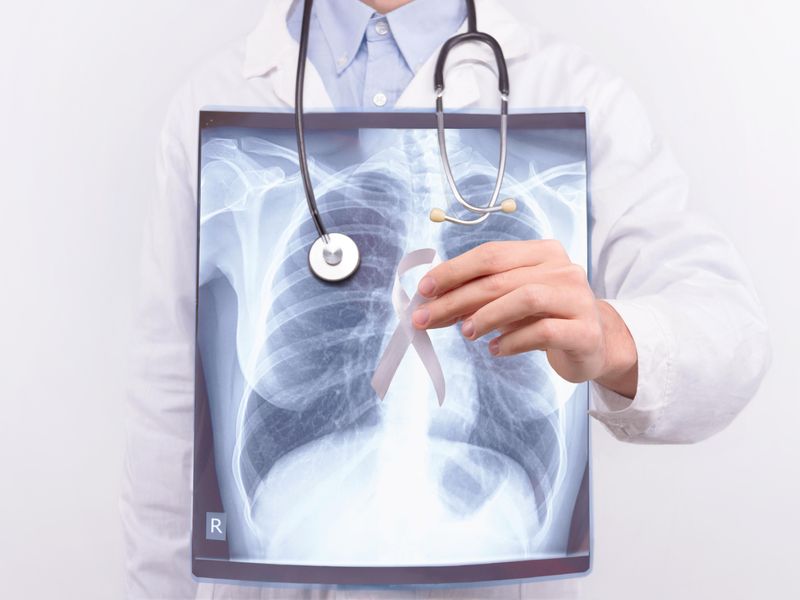Income, Education Linked to Advanced Stage of Diagnosis of NSCLC