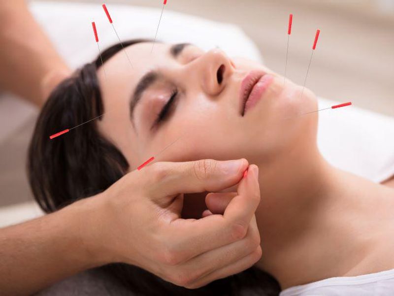 Acupuncture Reduces Frequency of Chronic Tension-Type Headaches