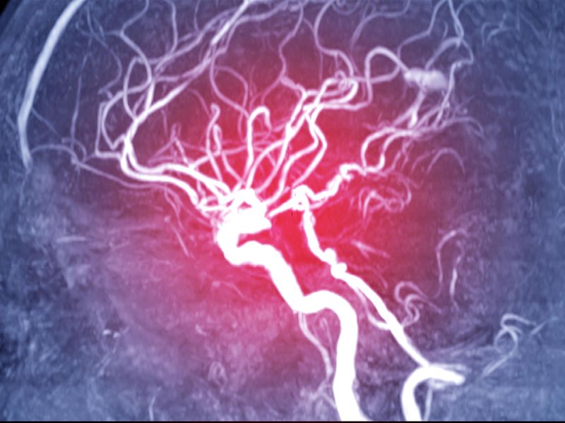 Genotype Tied to Endovascular Therapy Outcomes in LVO Stroke
