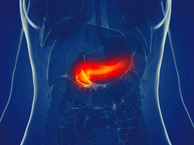 Surveillance of High-Risk Group May Downstage Pancreatic Cancer