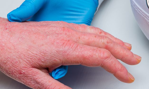 National Survey Shines Light on Complex Burden of Atopic Dermatitis