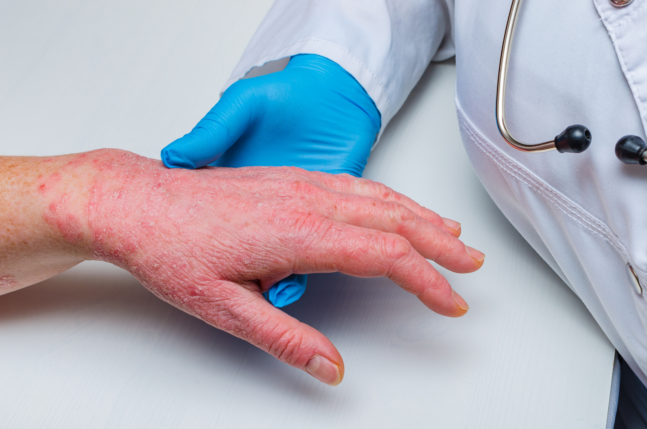 Baricitinib Offers New Hope for Patients With Lichen Planus