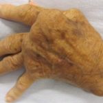 Methotrexate reduces functional burden of disease in patients with arthralgia at-risk of developing rheumatoid arthritis