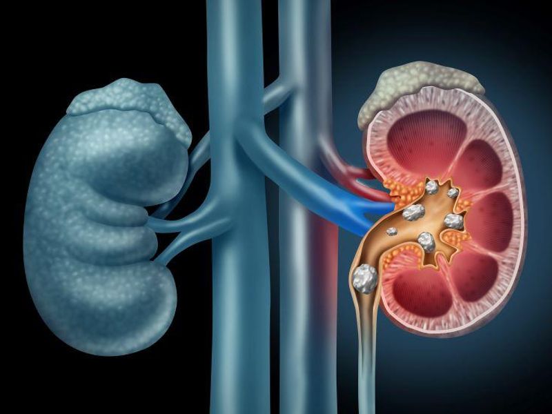 Removing Small, Asymptomatic Kidney Stones Beneficial