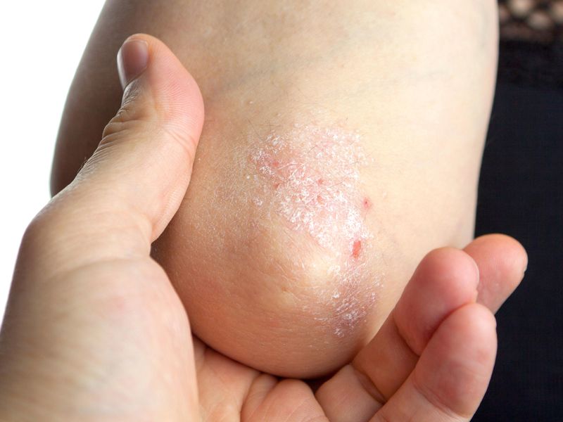 Causal Link Suggested for Psoriasis, Cardiovascular Disease