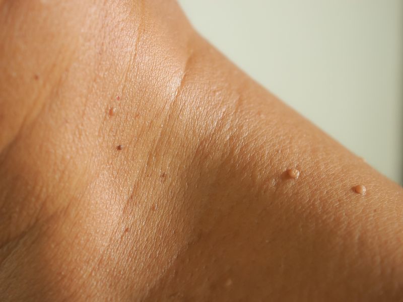 FDA Warns Amazon, Other Vendors About Sale of Skin Tag Removal Products