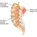 Graded sensorimotor retraining may improve chronic lower back pain compared to sham procedure: The RESOLVE randomized clinical trial