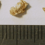 Removal of asymptomatic kidney stones reduces risk of relapse