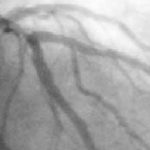 Fractional flow reserve guidance for percutaneous coronary intervention is similar to intravascular ultrasonography guidance