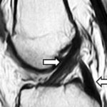 Surgical reconstruction is superior to non-surgical rehabilitation for non-acute anterior cruciate ligament tears