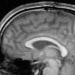 Excitatory noninvasive brain stimulation interventions improved negative symptoms in schizophrenia