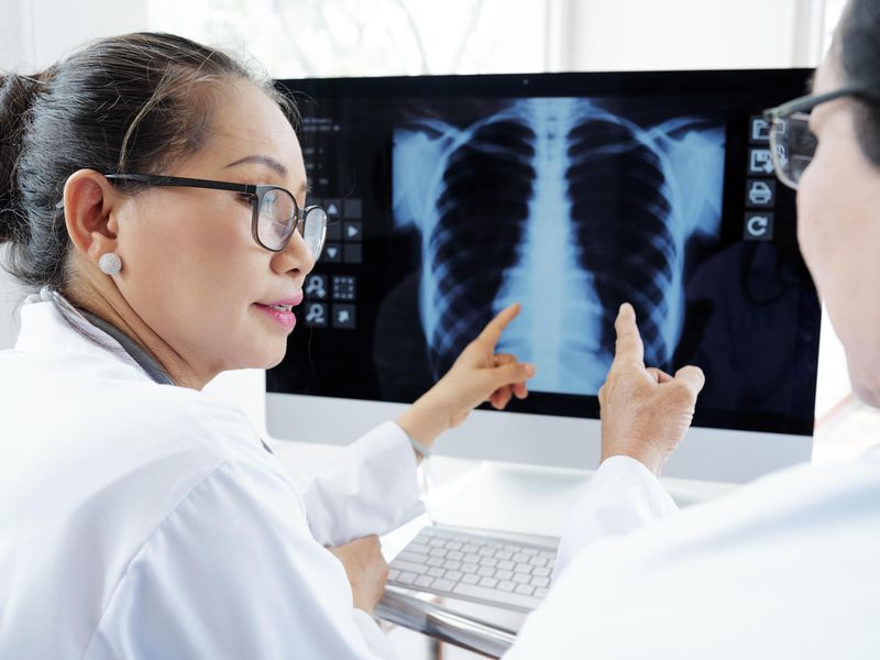 AI System Can Detect Pulmonary TB on Chest X-Rays