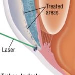 Selective laser trabeculectomy offers long-term benefits over eye drops for glaucoma