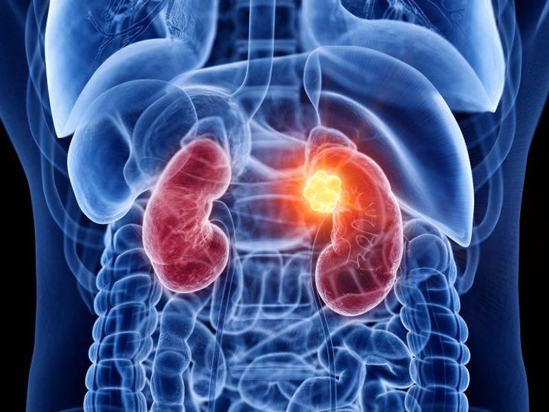 Triplet Therapy Ups Progression-Free Survival in Advanced Kidney Cancer