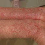 Dupilumab plus topical corticosteroids are effective in the treatment of childhood atopic dermatitis