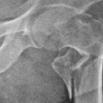 Risk of hip fracture in meat-eaters, pescatarians, and vegetarians
