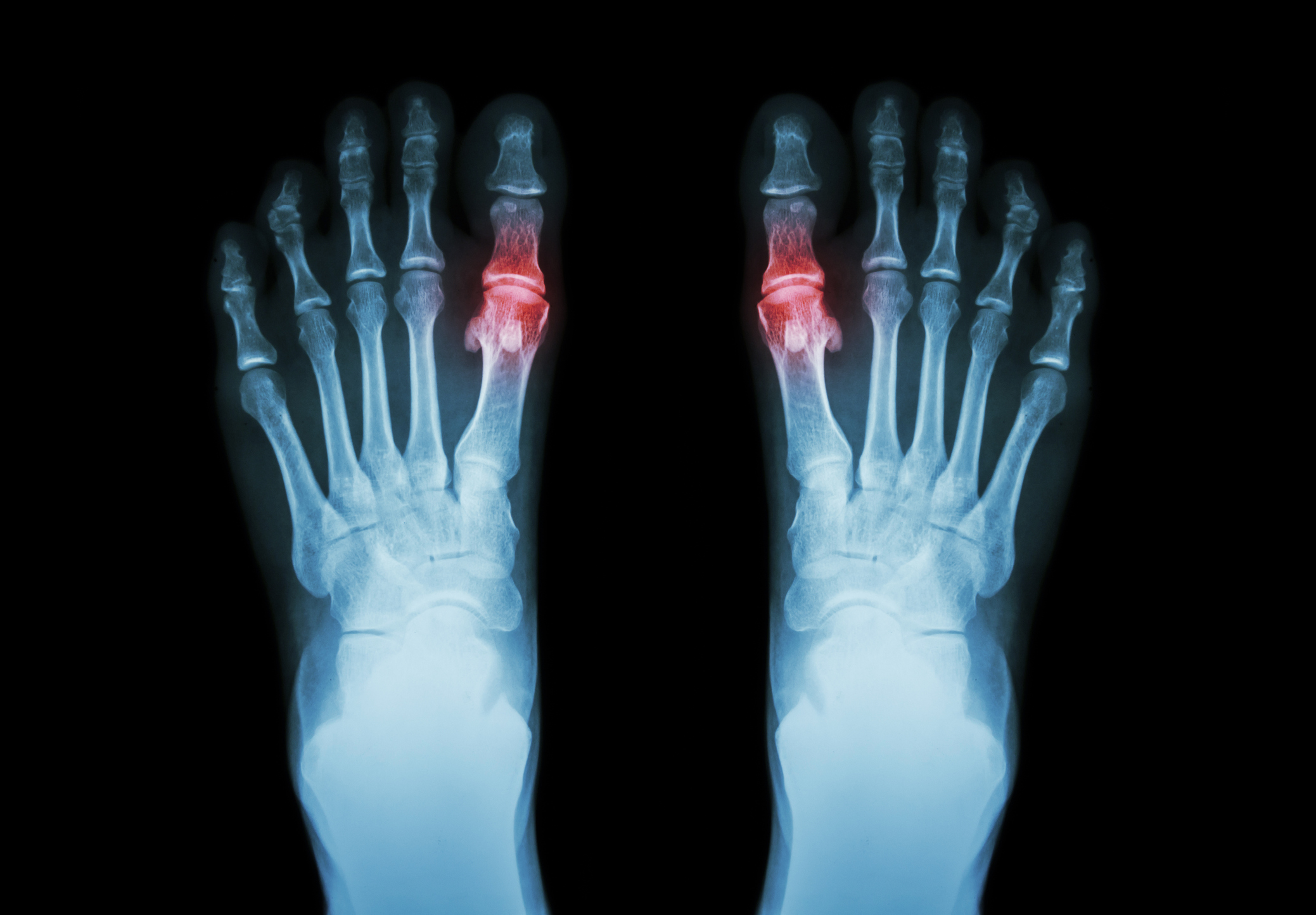 Neutrophil-to-Lymphocyte Ratio in Gout Suggests Sustained Post-Flare Inflammation