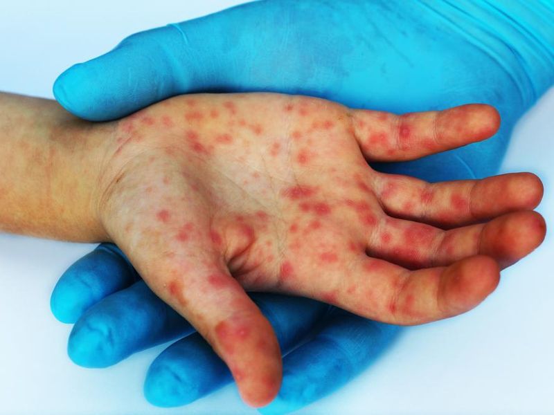 Rubella Elimination Likely to Be Achievable in All Countries