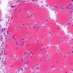 Intravenous immune globulin improved disease severity in dermatomyositis