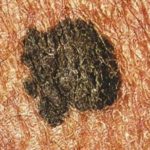 Ipilimumab addition to nivolumab showed no significant clinical benefit in resected advanced stage melanoma